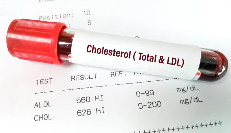 Một bộ lipid m&aacute;u c&oacute; thể phản &aacute;nh sự l&atilde;o h&oacute;a mạch m&aacute;u
