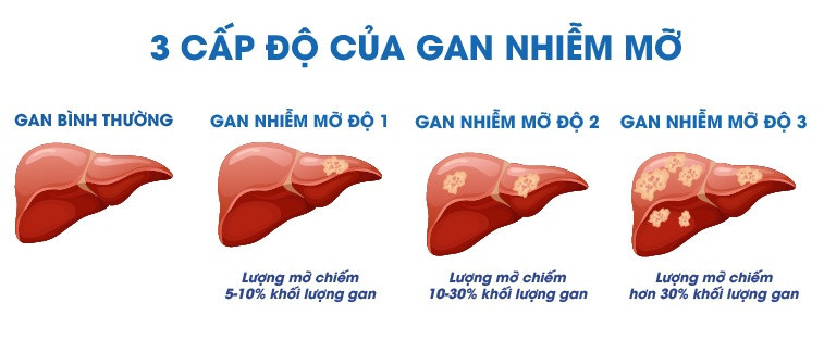 Bổ sung NMN chất lượng cao - Giải pháp cải thiện gan nhiễm mỡ cho phái mạnh