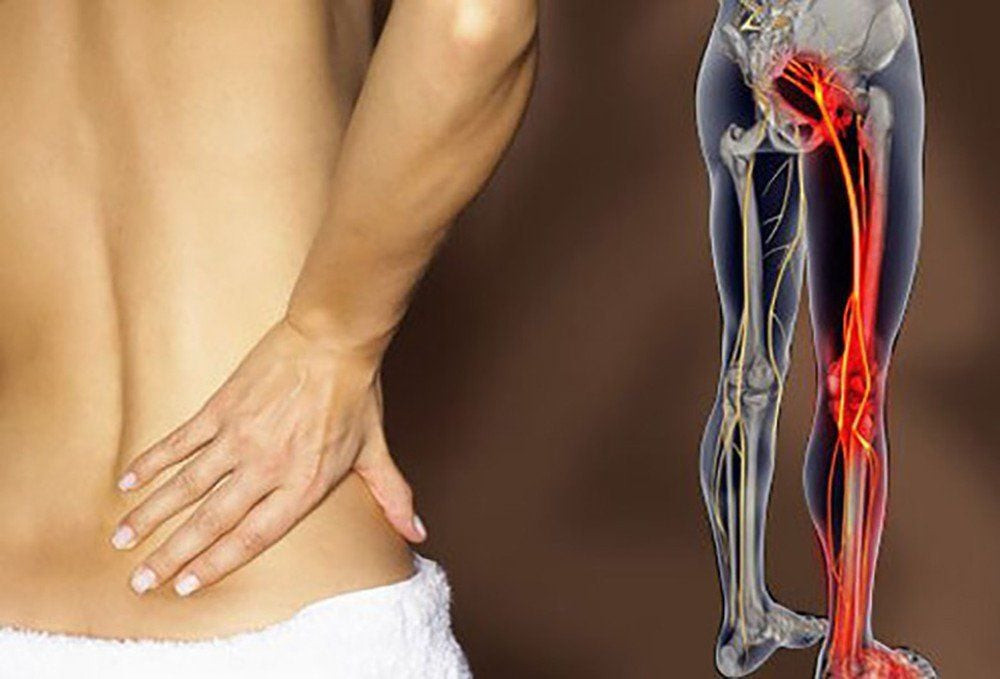 Đau thần kinh tọa ăn gì để giảm đau, phục hồi nhanh? Gợi ý từ chuyên gia